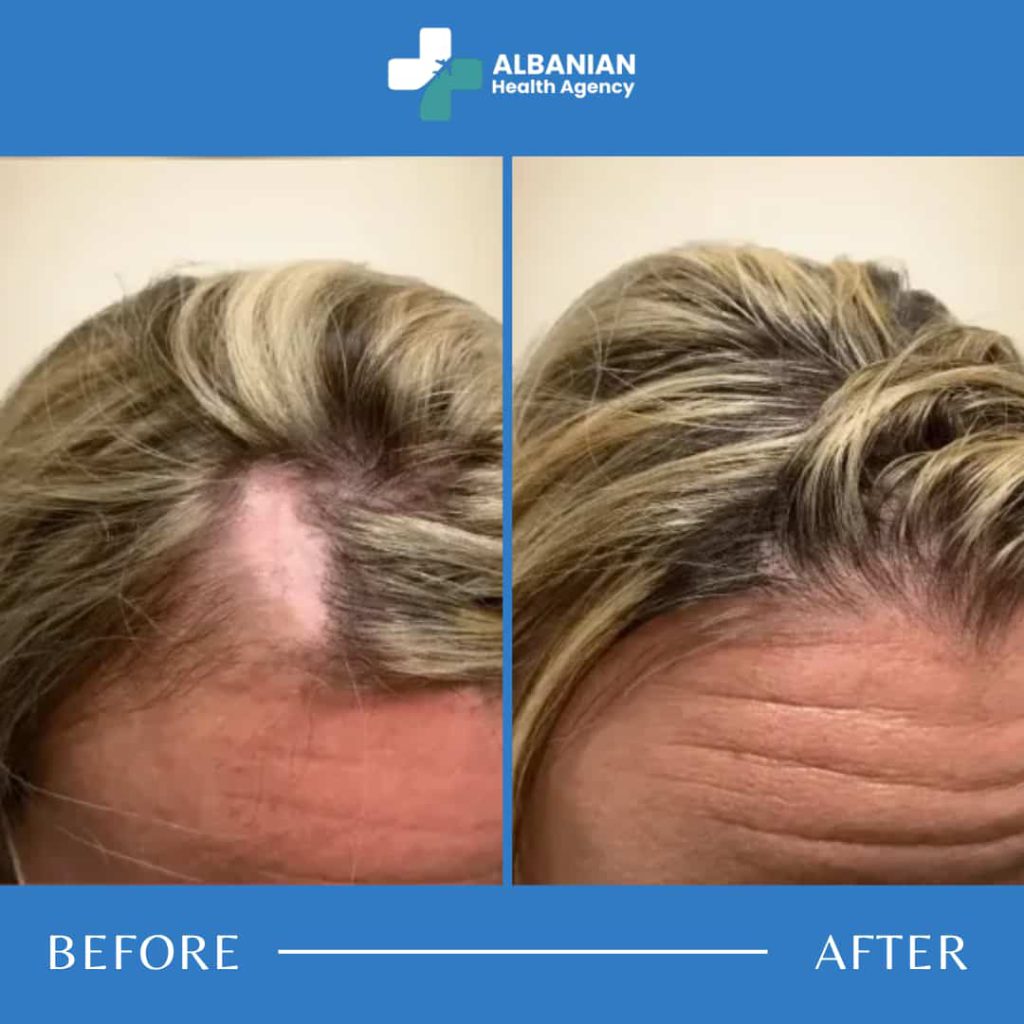 hair-transplant-women-albania