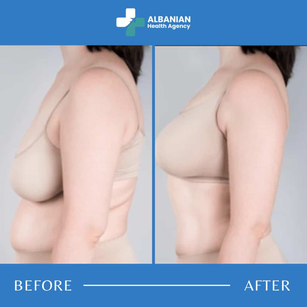 breast-surgery-albania