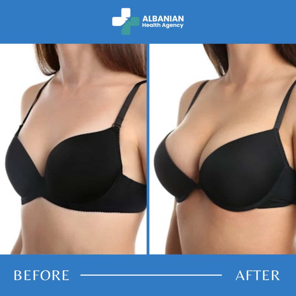 breast-surgery-albania