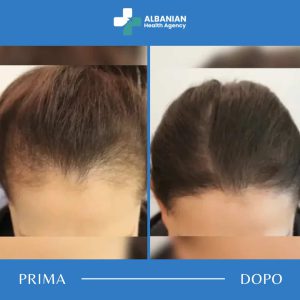 Trapianto Capelli Donne Albania