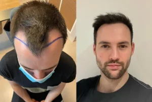 hair transplant in Turkey