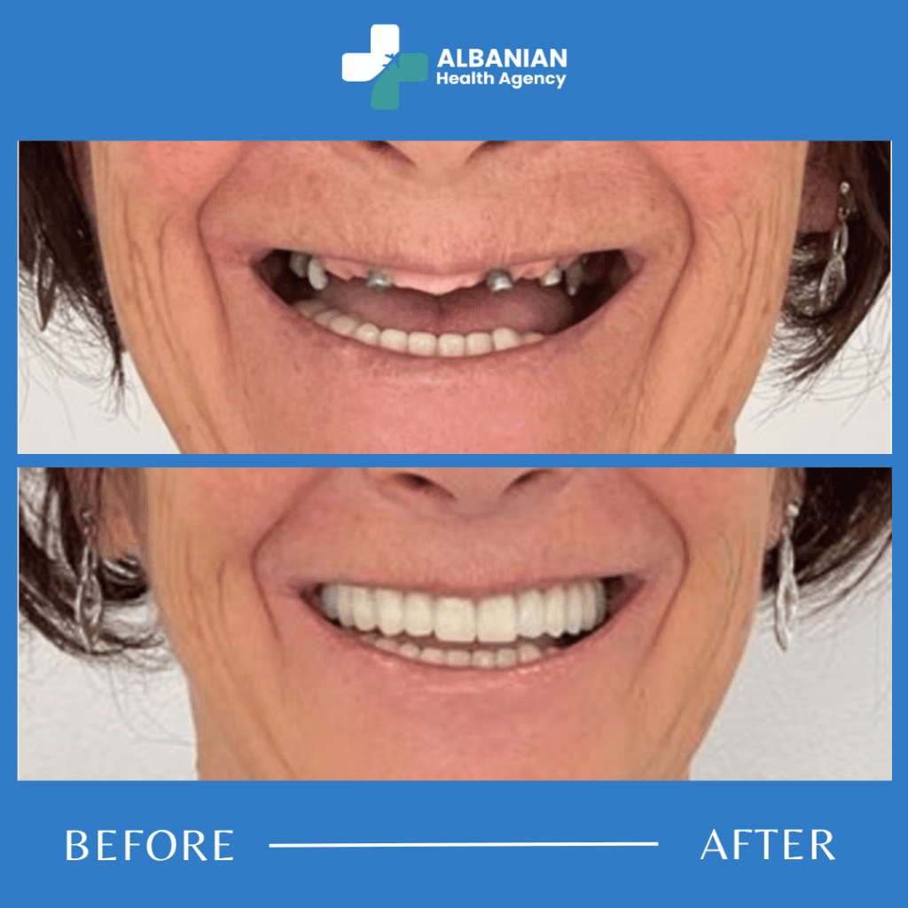 Dental Implants in Albania