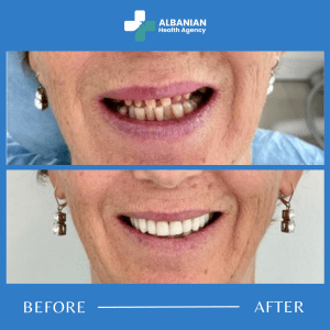 Dental Implants in Albania