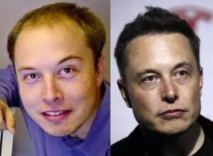 Explore the journey of Elon Musk in the hair transplant sector and how he saved his hairline and discover the new technologies in this field.