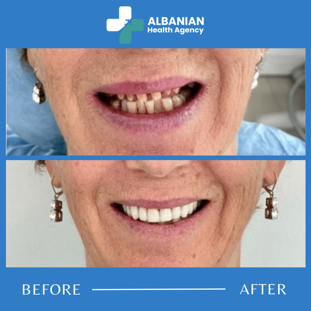 Dental Implants in Albania