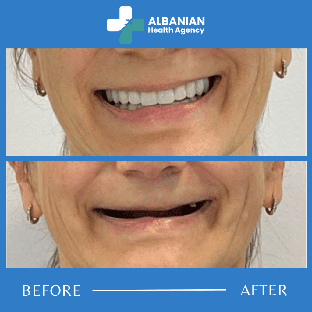 Dental Implants in Albania