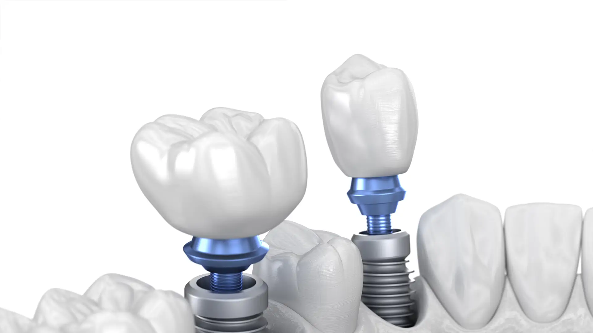 Average Cost of Dental Implants in Albania