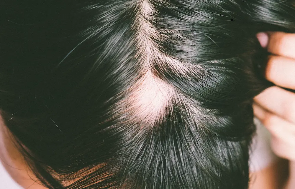 Alopecia Areata