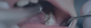 Endodonzia in Albania