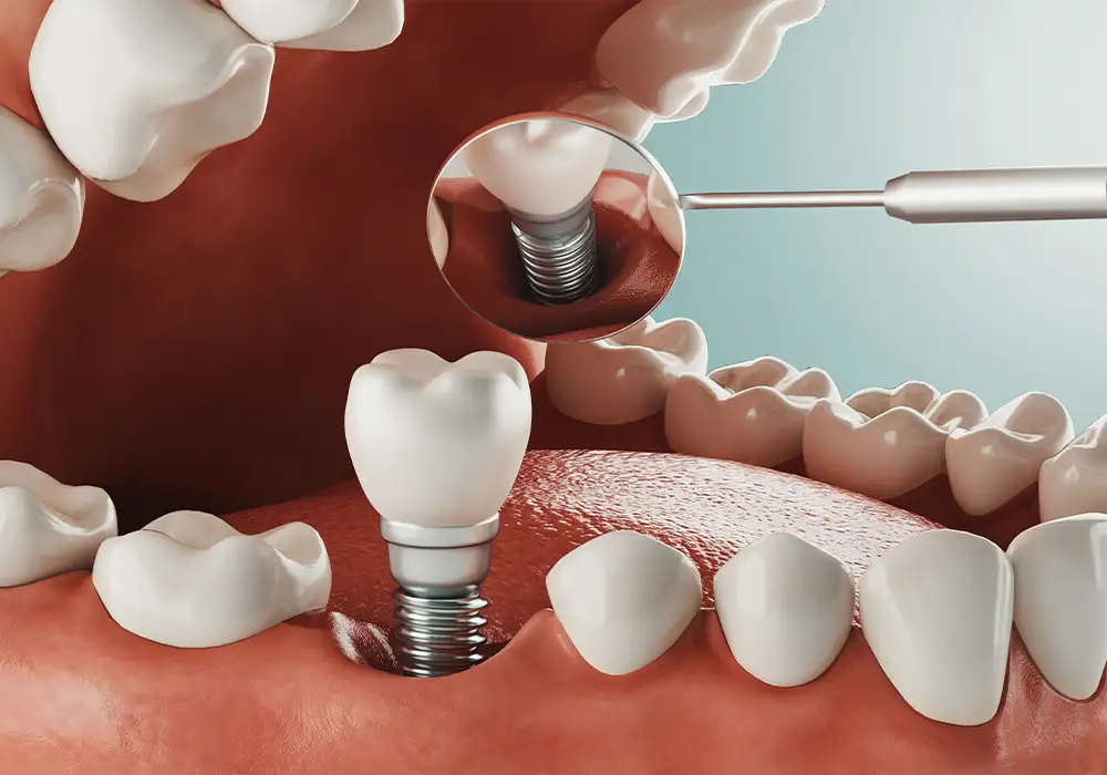 Quanto Costa un Impianto Dentale in Albania