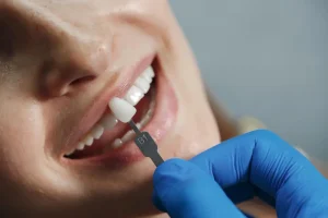 quanto costano le faccette dentali