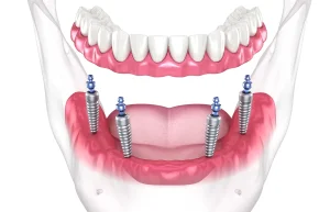 Todo sobre implantes dentales 4/6