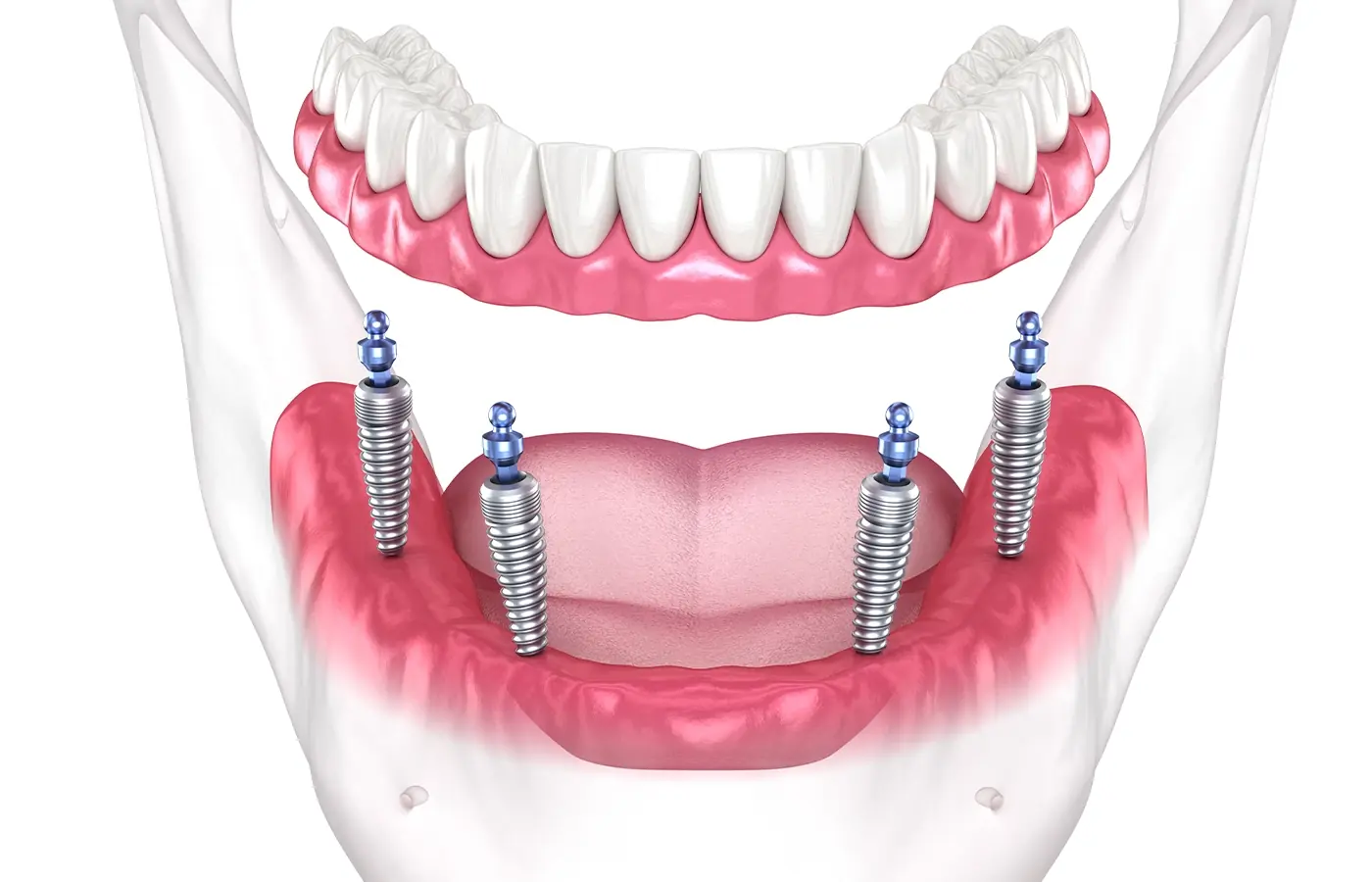 full mouth dental implants