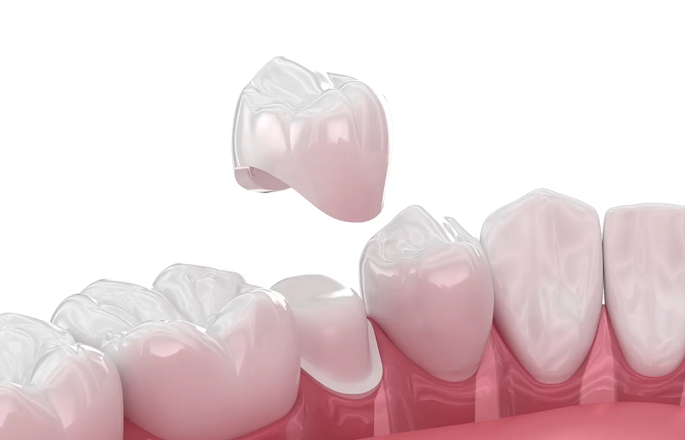 Zirconium Oxide Dental Crowns