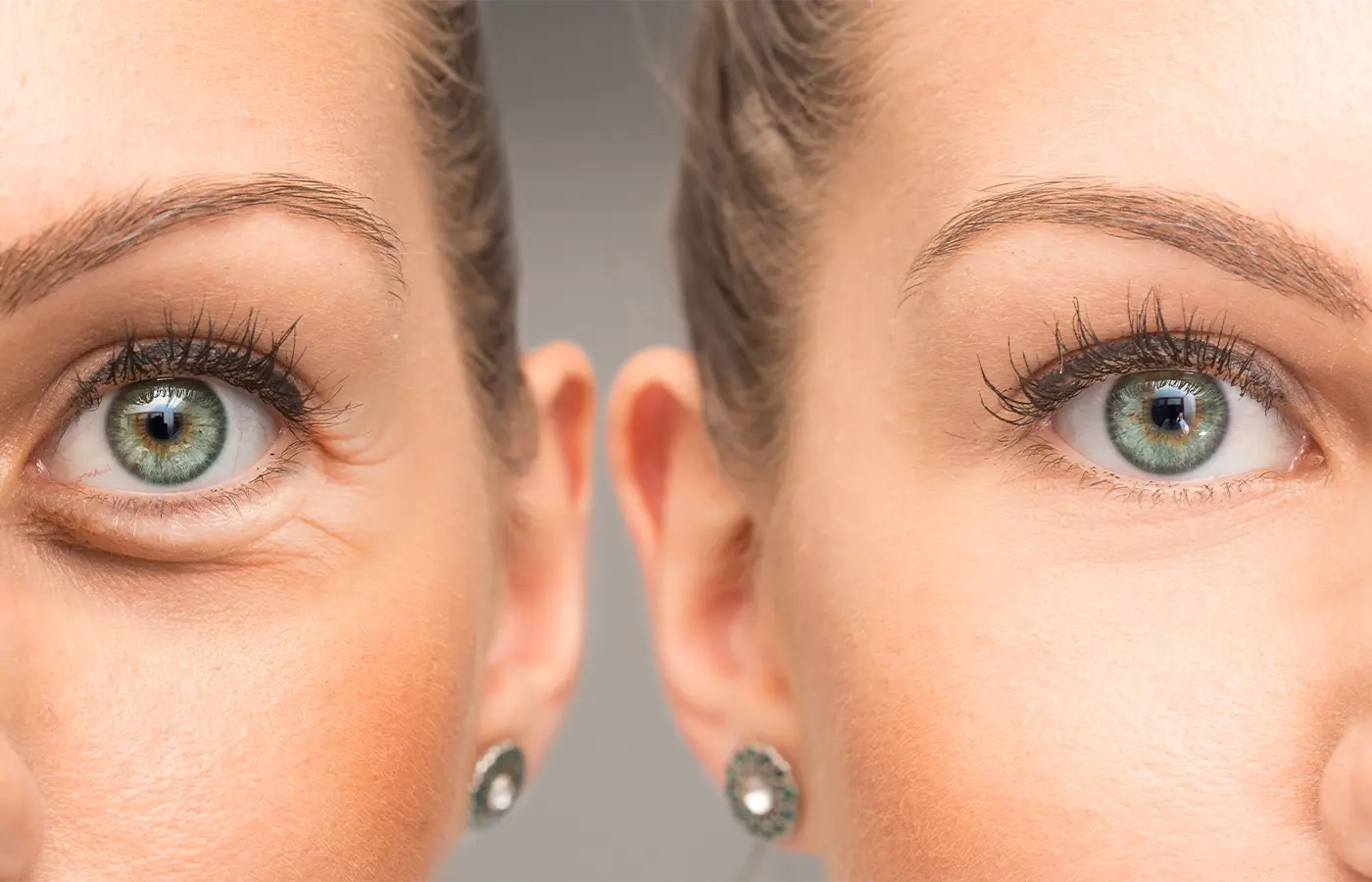 Learn all about blepharoplasty, the cosmetic procedure that rejuvenates the look by removing excess skin and fat from the eyelids.