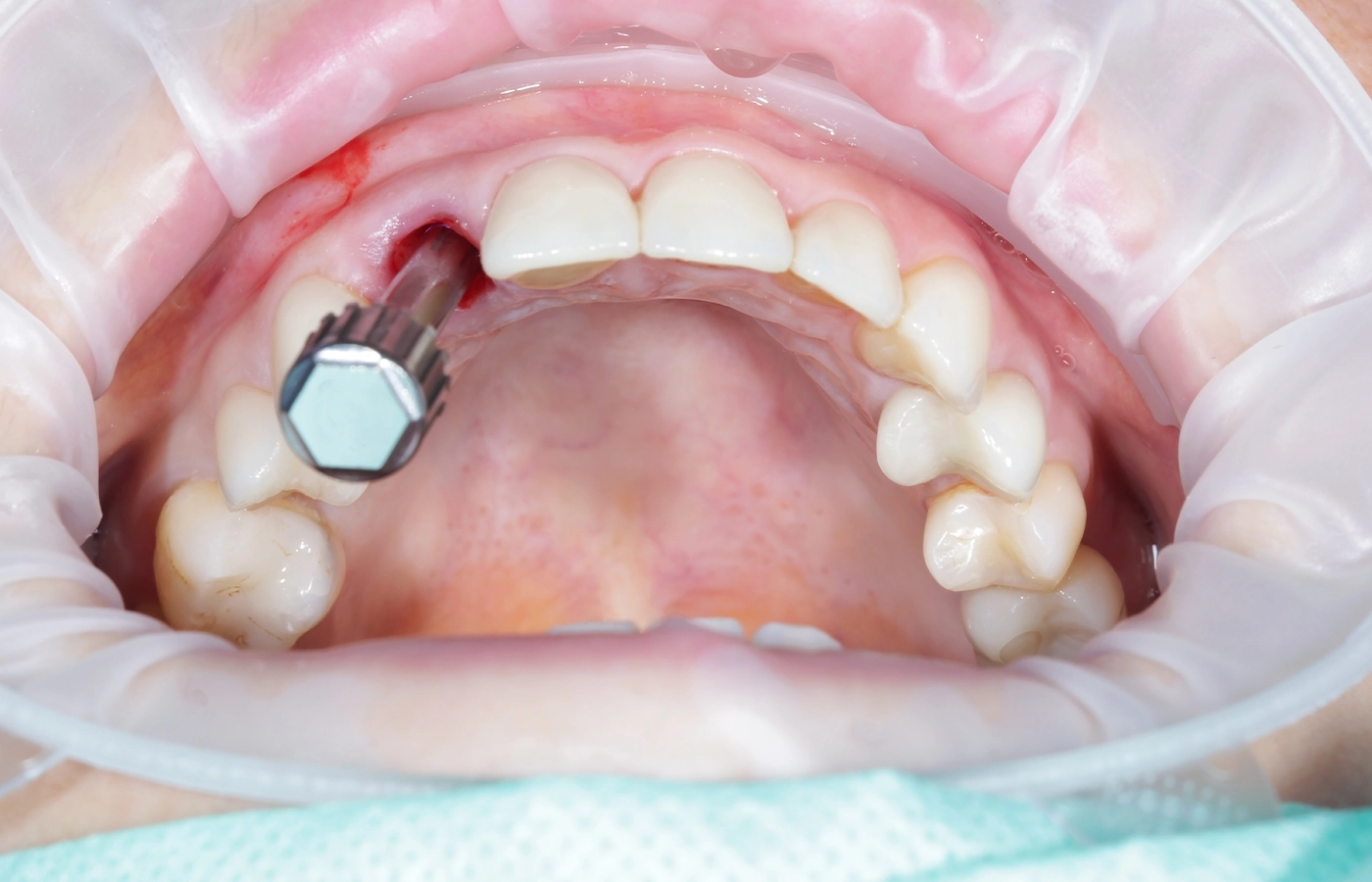 Costo de los implantes dentales de boca completa