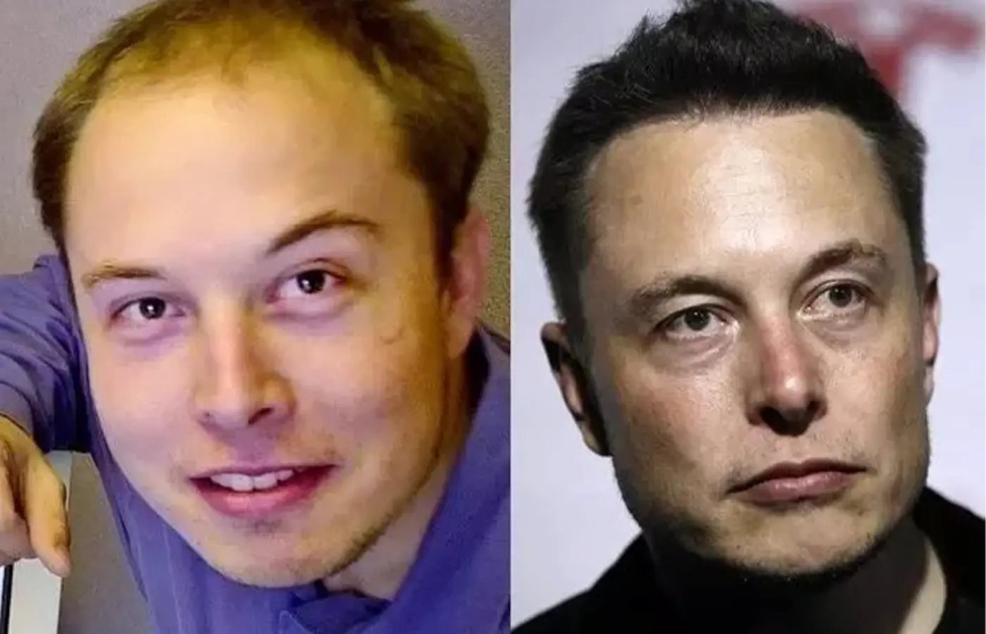 Elon Musk Trasplante de Cabello