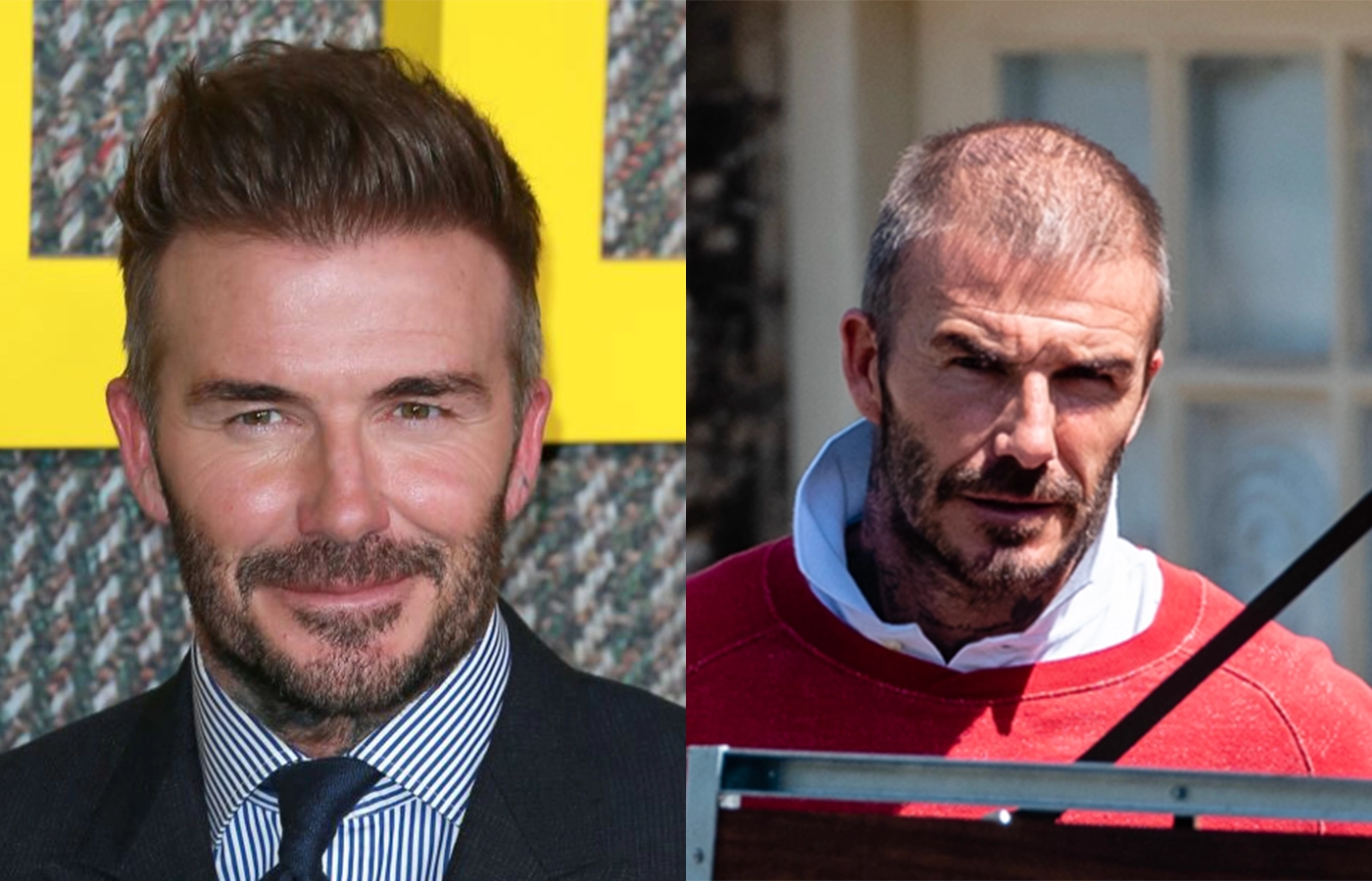 David Beckham hair transplant