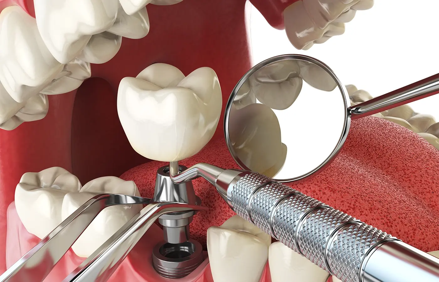 Learn about the different types of dental implants available today. Discover which option suits your needs best with our in-depth guide. Explore implant types, materials, and techniques.