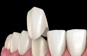 types of dental crowns