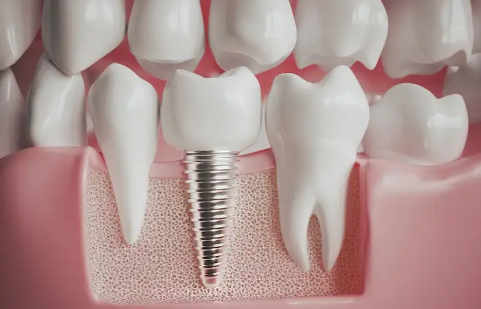 Discover the 8 signs that you need dental implants to restore your smile and improve oral health. Learn about their benefits and value