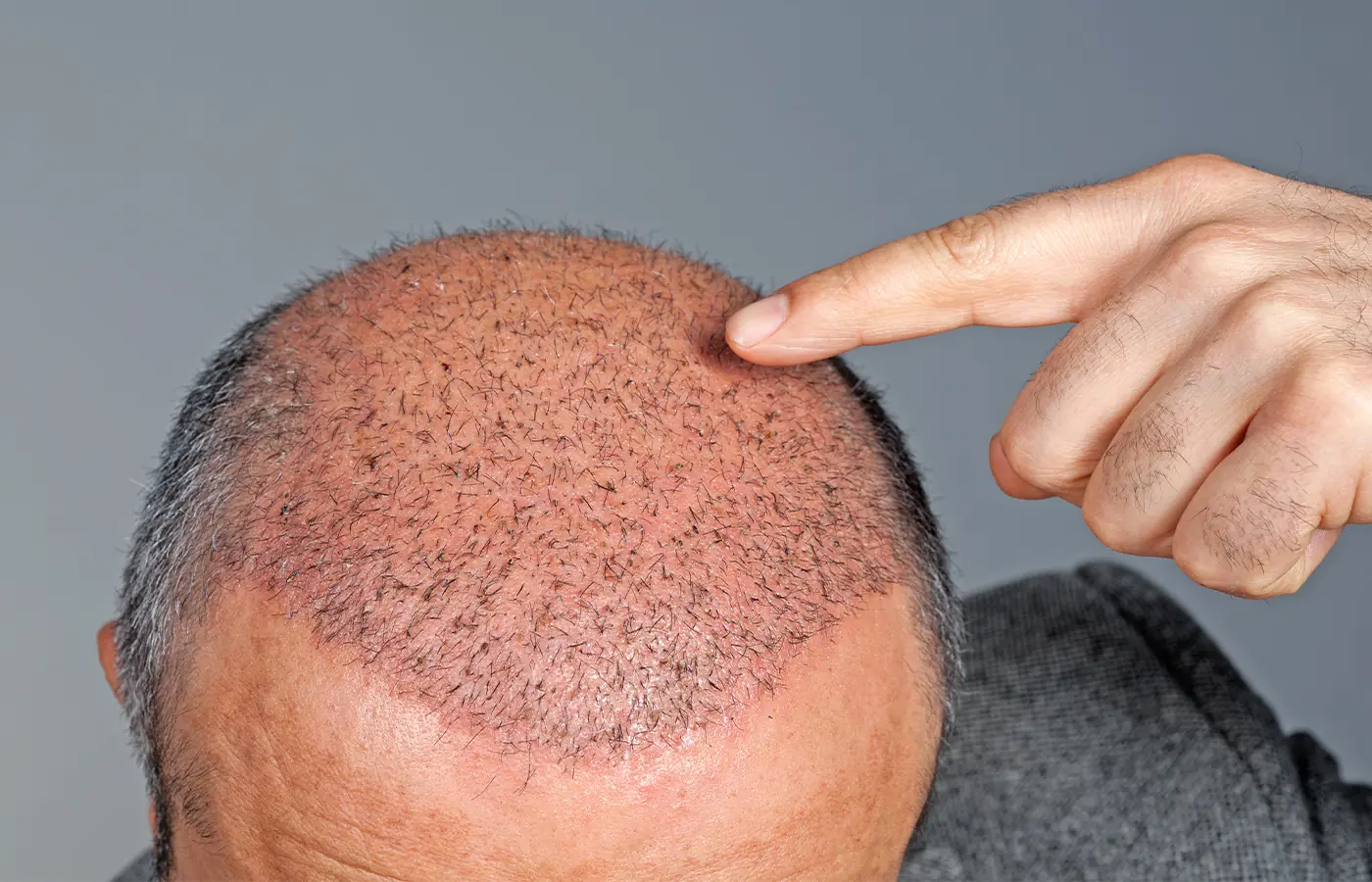 How Long Can a Hair Transplant Grow