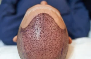 5 Things to Do Before Getting a Hair Transplant