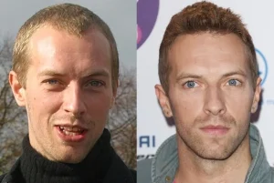 Chris Martin hair transplant before and after