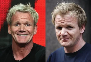 Gordon Ramsay hair transplant