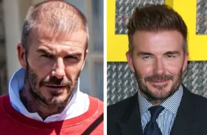 David Beckham hair transplant before and after