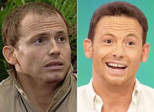 Joe Swash hair transplant