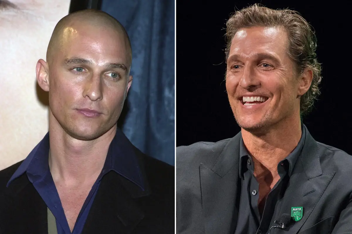 Matthew McConaughey hair transplant before and after