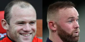 Wayne Rooney hair transplant