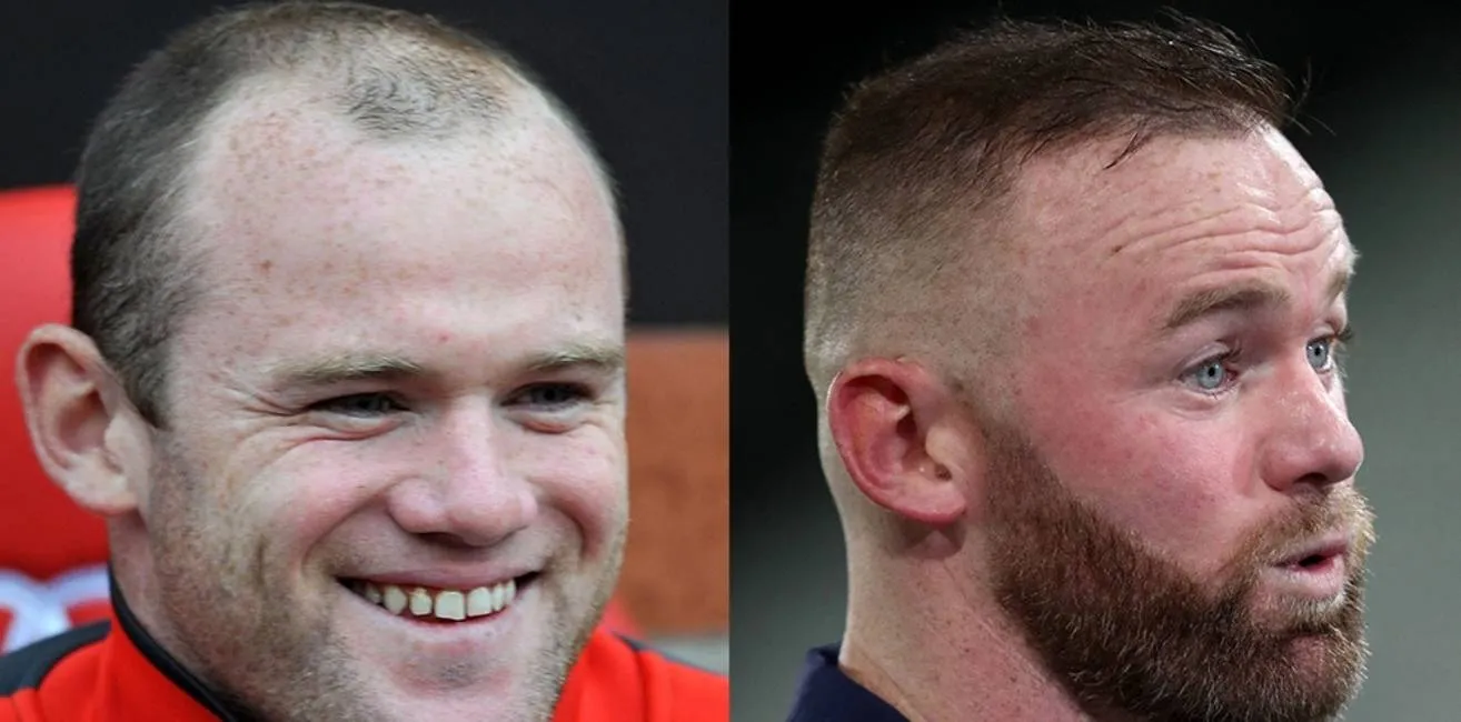 Wayne Rooney hair transplant