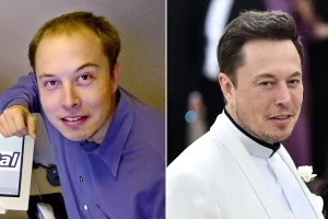 elon musk hair transplant