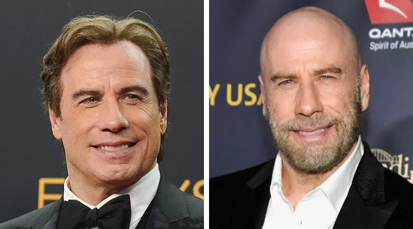 john travolta hair transplant before and after