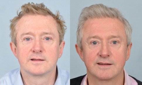 Louis Walsh hair transplant before and after