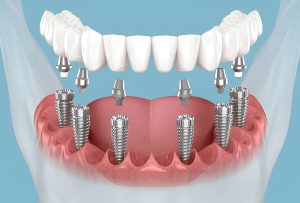 Scopri gli impianti dentali All-on-4 e All on 6 in Albania: soluzioni innovative per un sorriso perfetto a prezzi competitivi. Cliniche moderne, dentisti esperti e risparmio fino al 70%.