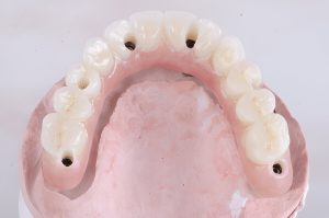Scopri gli impianti dentali All-on-4 in Albania: una soluzione conveniente e duratura per un sorriso perfetto. Risparmia fino al 70% rispetto ad altri Paesi senza compromettere la qualità!
