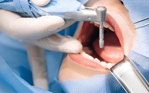 Discover the best dental tourism destinations worldwide. Learn why Albania is emerging as a top choice for high-quality dental care