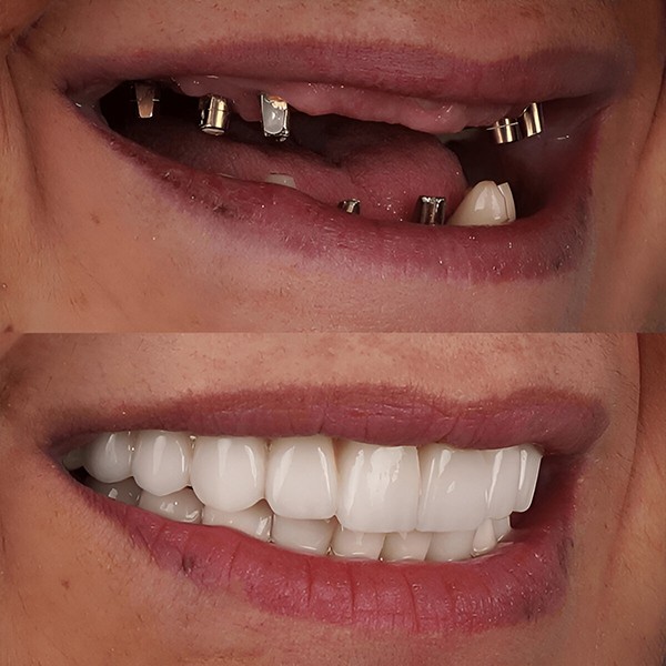 See stunning dental implants before and after results with Albanian Health Agency. Transform your smile with expert care and affordable prices!