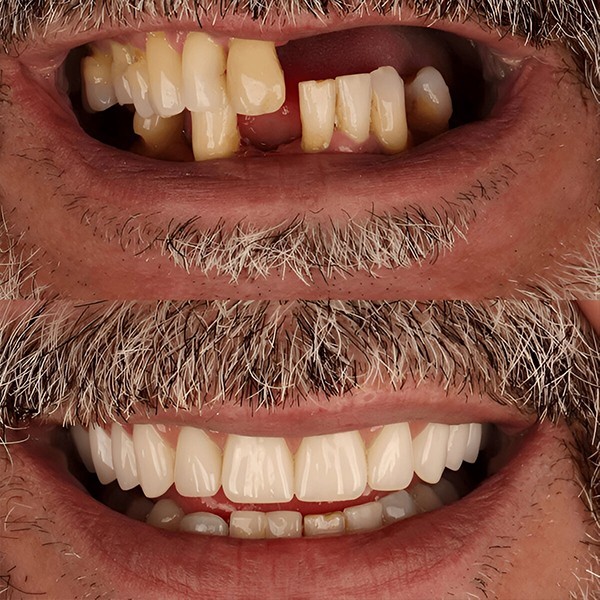 Visualizza i cambiamenti Impianti dentali prima e dopo: risultati reali, professionalità e innovazione per trasformare il tuo sorriso.