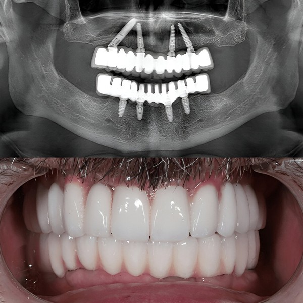 Scopri i risultati sorprendenti con Impianti dentali prima e dopo: guarda le trasformazioni reali e prenota la tua consulenza per un sorriso nuovo!