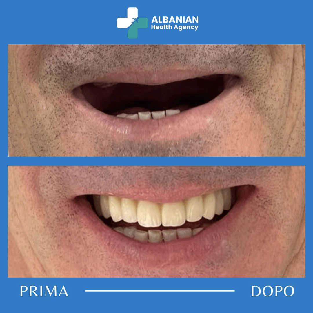 Dramatic before and after transformation of a dental bridge treatment in Albania.