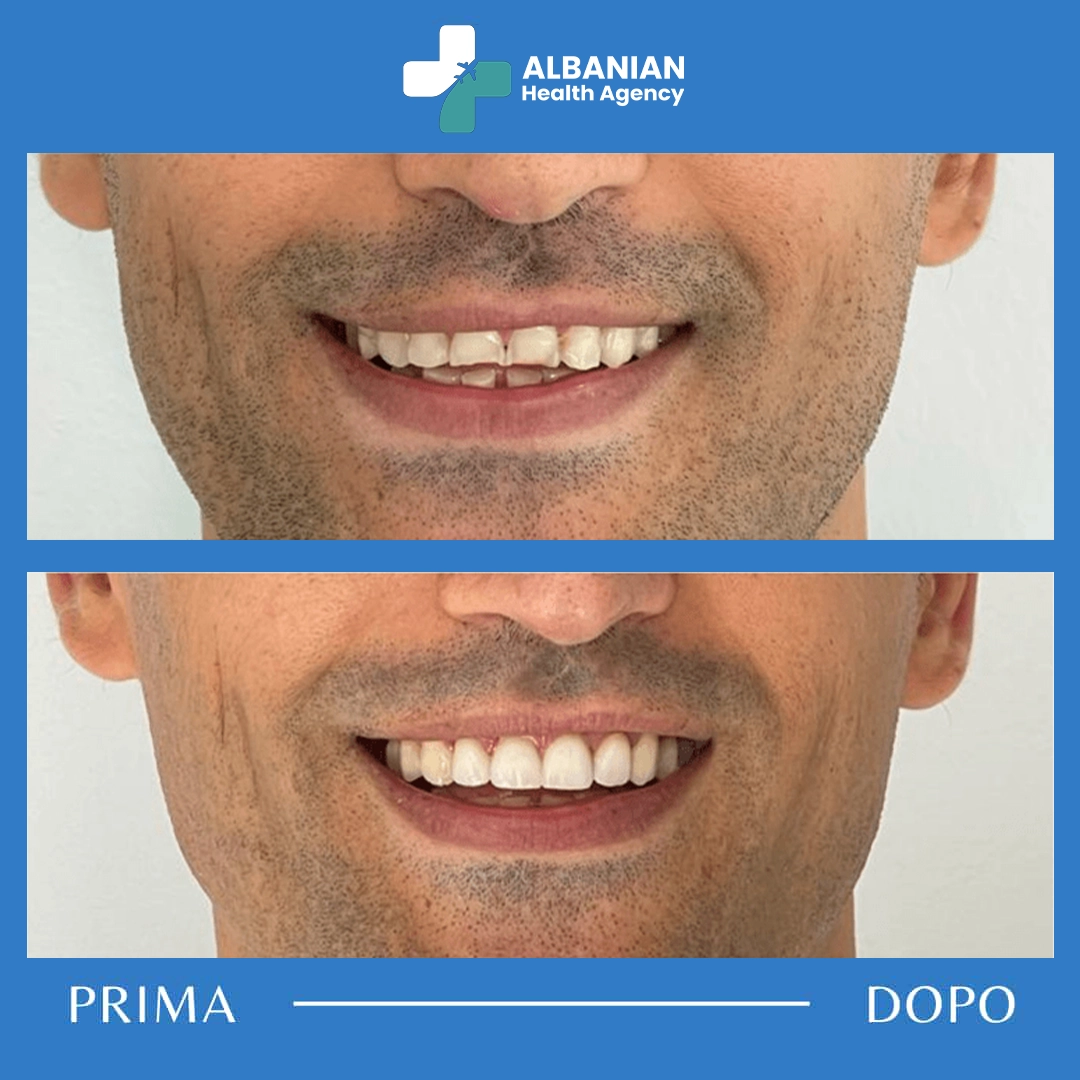 Successful full-mouth restoration – before and after dental tourism in Albania.