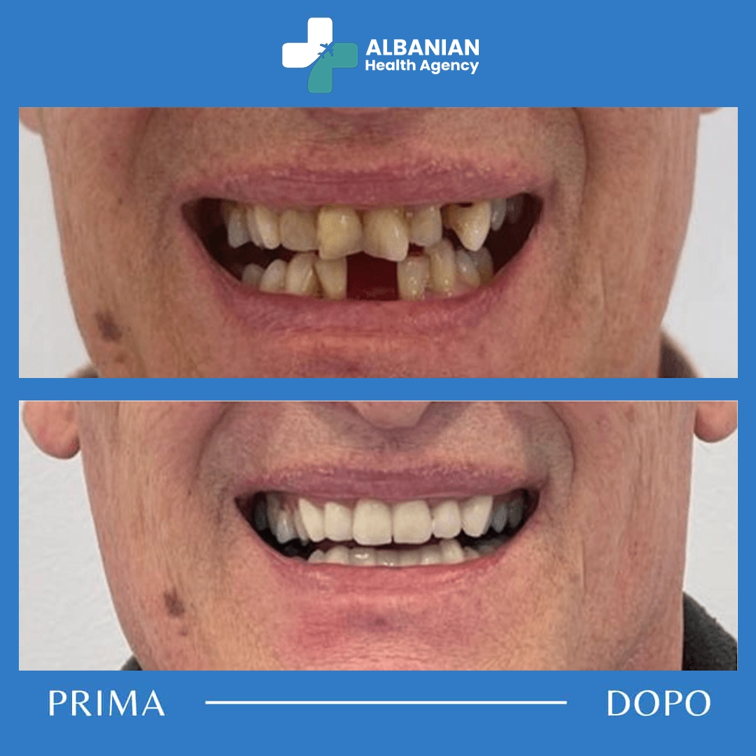 Before and after teeth whitening results from dental tourism in Albania.