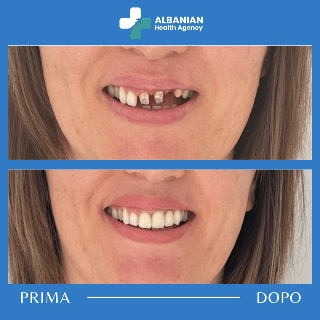 Before and after results of a successful dental implant procedure in Albania.