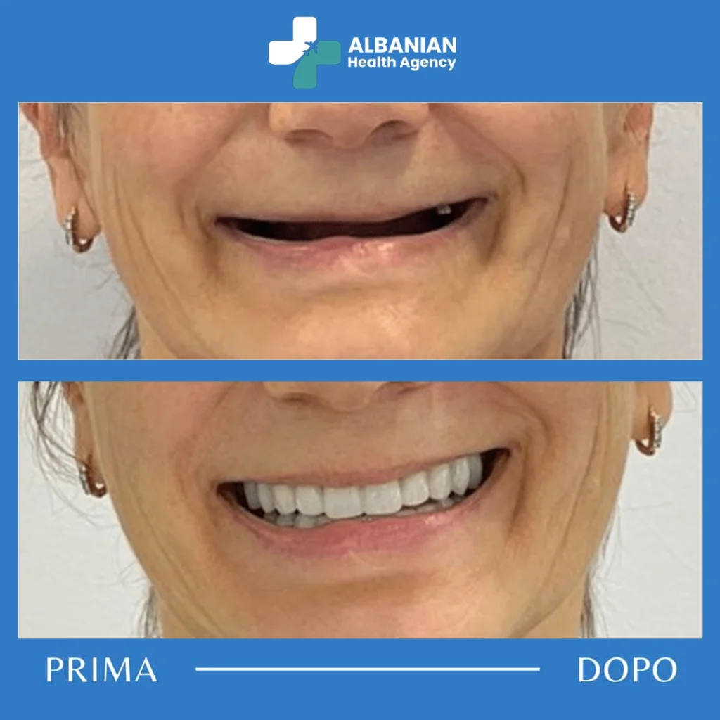 Scegli gli impianti dentali in Albania per un sorriso sano, grazie alla professionalità dei nostri dentisti esperti.