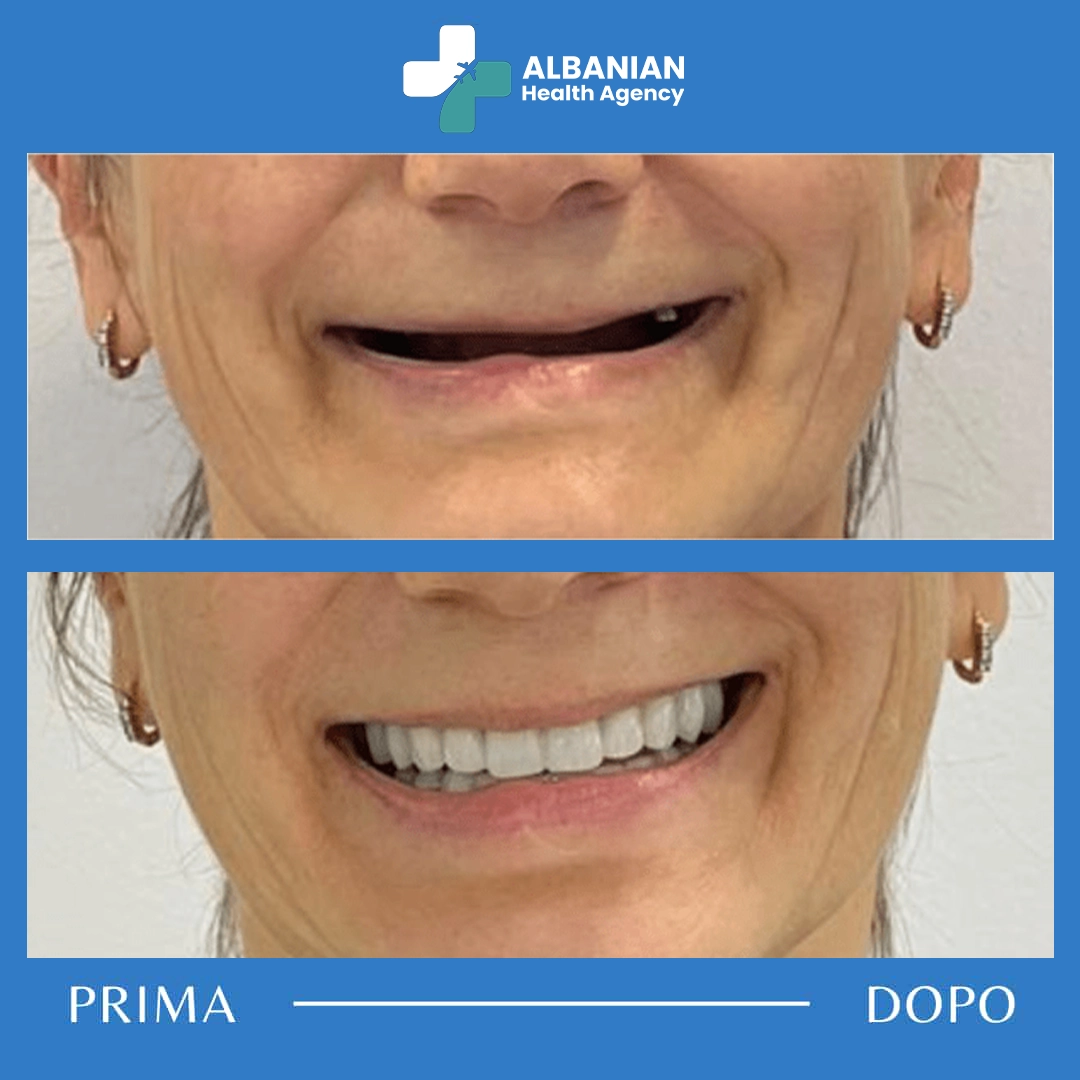 Patient's smile transformation before and after dental veneers in Albania.