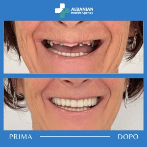 I migliori impianti dentali in Albania: soluzioni dentistiche moderne a prezzi accessibili per i pazienti internazionali."